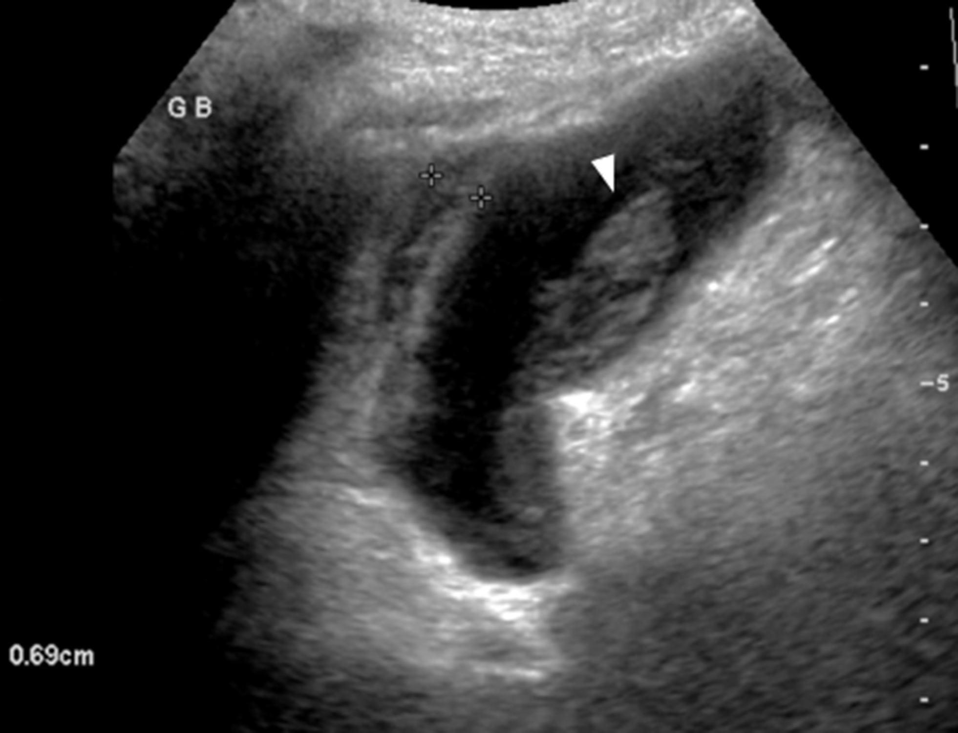Abdominal_Rad's tweet card. Abdominal Radiology - In this review, we highlight current understanding of the pathogenesis of acalculous cholecystitis, as well as its key imaging and clinical features. We also review what...