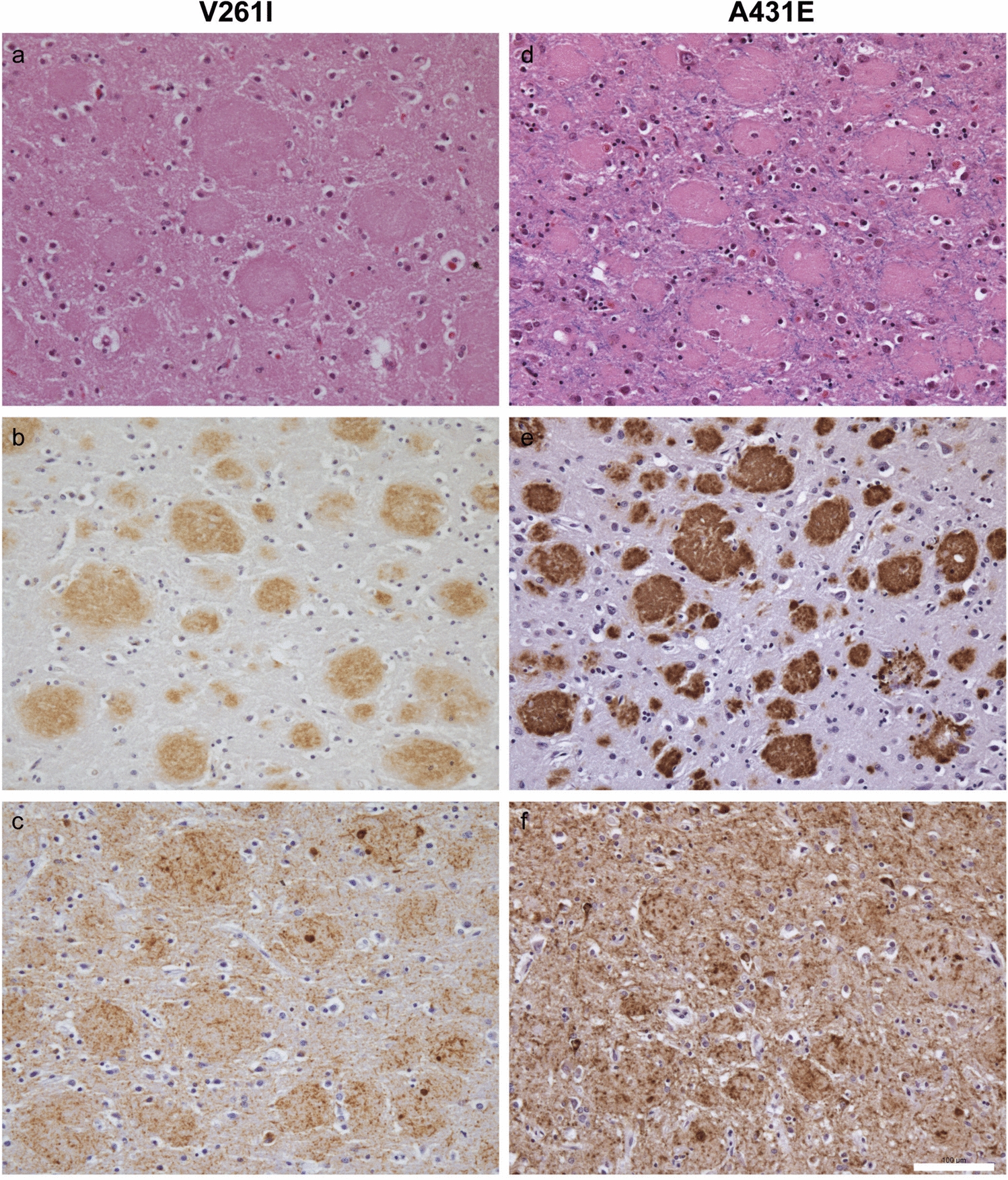 andrewmstern's tweet card. Acta Neuropathologica - Cotton wool plaques (CWPs) have been described as features of the neuropathologic phenotype of dominantly inherited Alzheimer disease (DIAD) caused by some missense and...