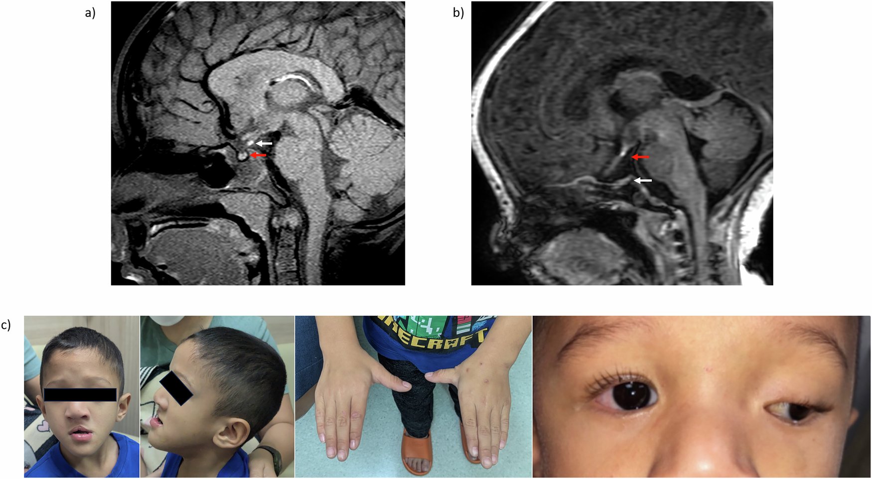 FranMartinezGr's tweet card. Journal of Human Genetics - Expanding the clinical and molecular spectrum of TBC1D32-related ciliopathy: case reports and literature Review