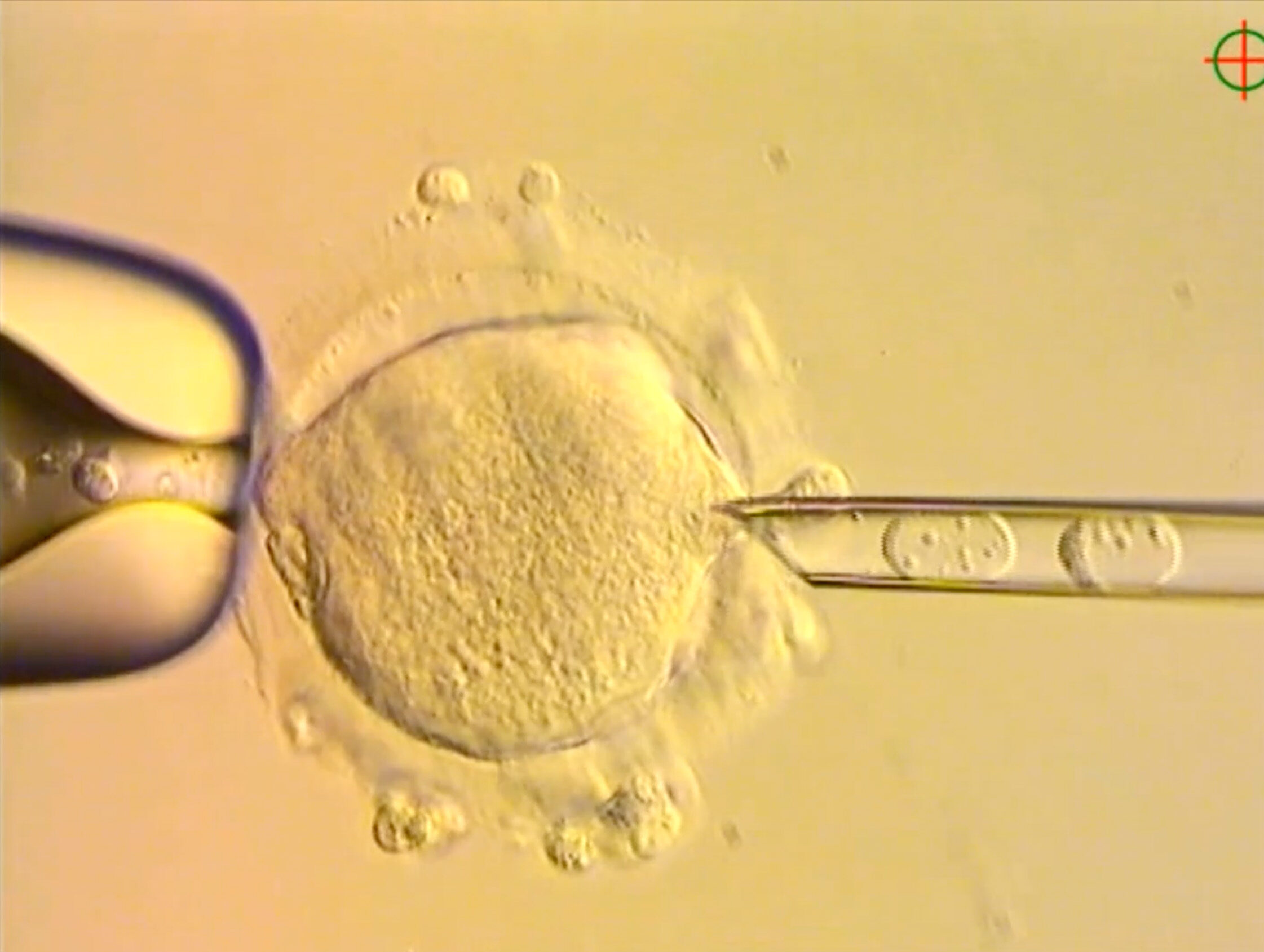 nhsfyp's tweet card. The UK’s pioneering licensed IVF technique to reduce the risk of mitochondrial diseases carried out in Newcastle has seen eight babies born, published research shows.