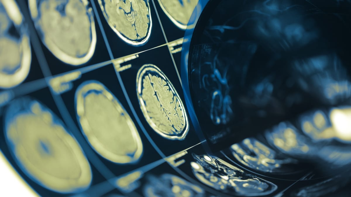 SENC_'s tweet card. Una investigación española ha identificado una asociación entre determinados eventos vitales estresantes y alteraciones en la salud cerebral.