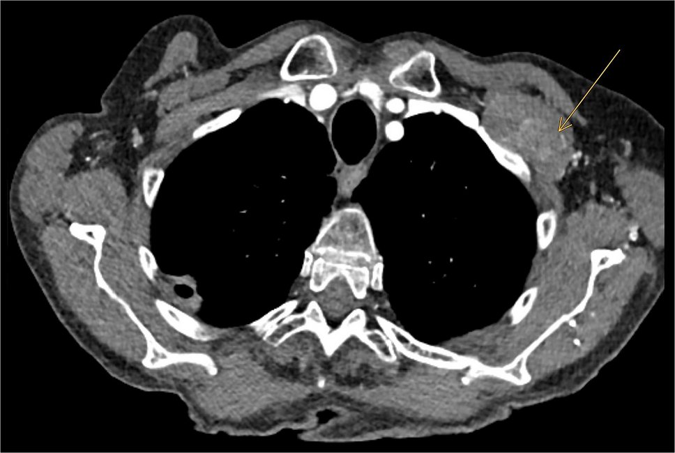 SpringerPath's tweet card. Virchows Archiv - Epithelioid hemangioendothelioma (EHE) is a rare vascular tumor of intermediate malignant potential. Most cases are characterized by a WWTR1::CAMTA1 gene fusion, with YAP1::TFE3...