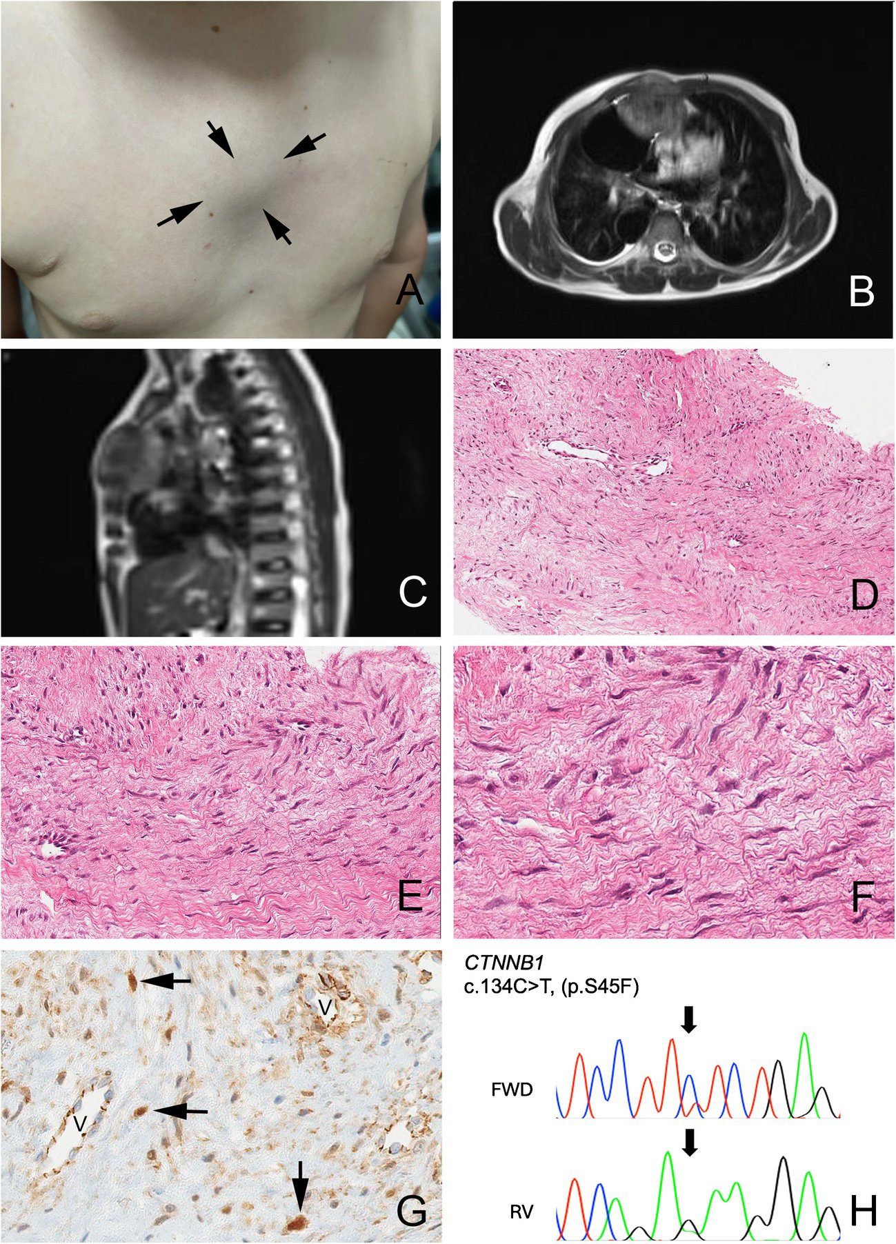 SpringerPath's tweet card. Virchows Archiv - DICER1-related tumor predisposition is an inherited disorder, generally pediatric in onset, featuring a characteristic array of mainly mesenchymal tumors. We report a chest wall...