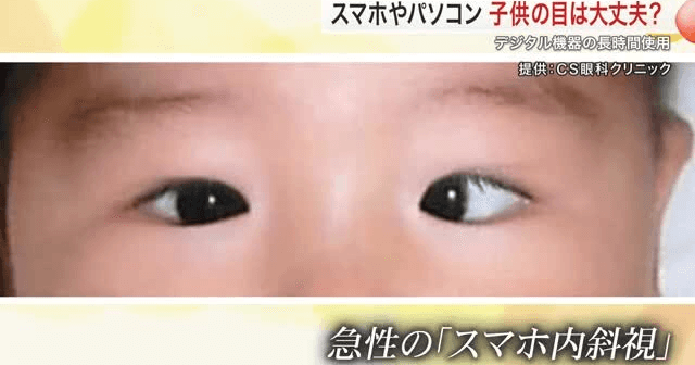 mukomizu's tweet card. 宮城県内の多くの小中学校が夏休みに入りましたが、今、若い世代で増加しているのが、スマートフォンなどを長時間・近距離で使用することによる目への影響です。スマホなどを長時間使うことによって視力の低下だけでなく、このように片方の目が内側に寄る「内斜視」になってしまう人も増えています。原因と予防方法を聞きました。いまや私...