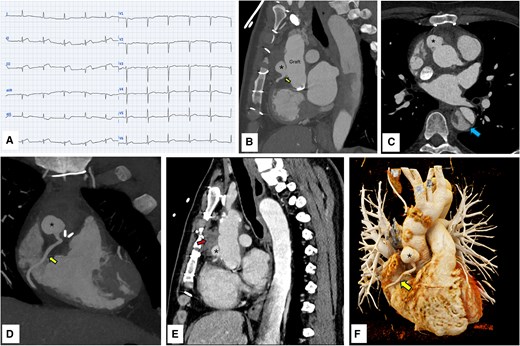 DrDamandeep's tweet card. A 40-year-old gentleman presented to the emergency with acute chest pain. The patient complained of fever and cough of 3-week duration prior to the onset o
