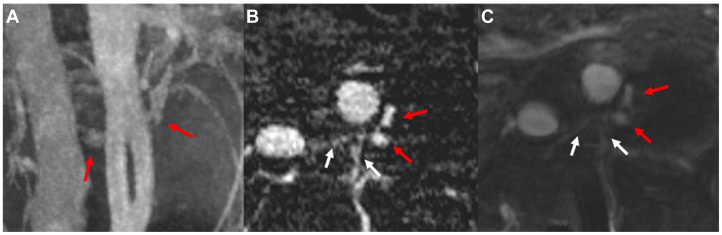 JVascSurgCIT's tweet card. Endovascular aneurysm repair requires lifelong imaging surveillance, typically with contrast-enhanced computed tomography imaging. This poses risks to patients with end-stage renal disease. Ferumox...