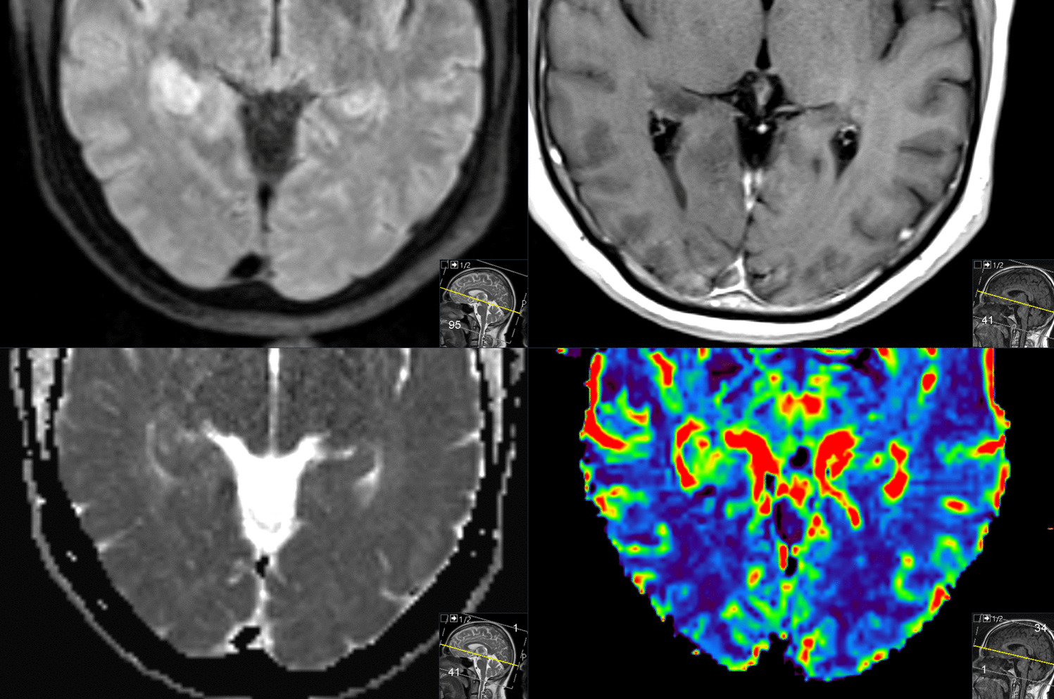 ActaNeuro's tweet card. Acta Neurochirurgica - Glial tumors and especially glioblastoma present a major challenge in neuro-oncology due to their infiltrative growth, resistance to therapy, and poor overall...