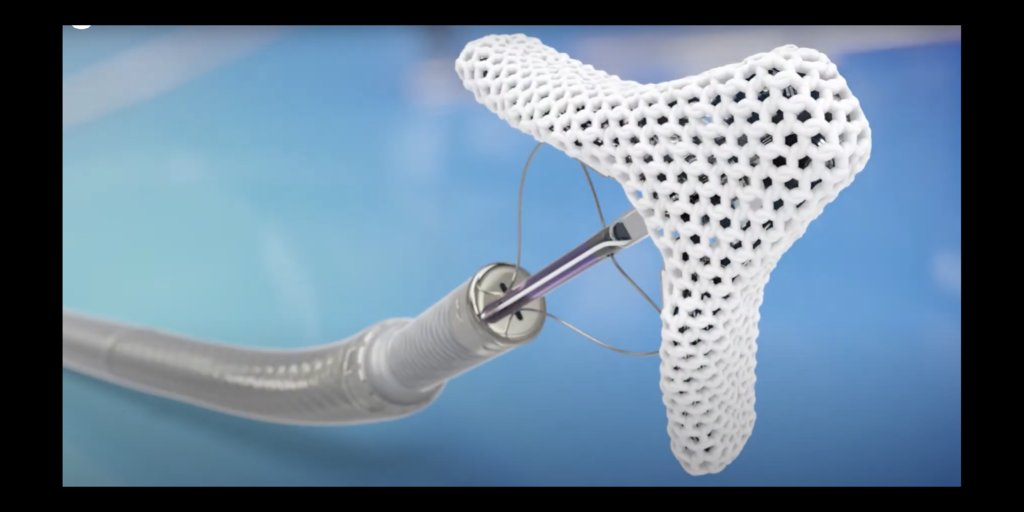 SCAI's tweet card. CMS has finalized a new national coverage determination for T-TEER, sometimes known as transcatheter tricuspid valve repair. Abbott's TriClip is the only device approved by the FDA for T-TEER, but...