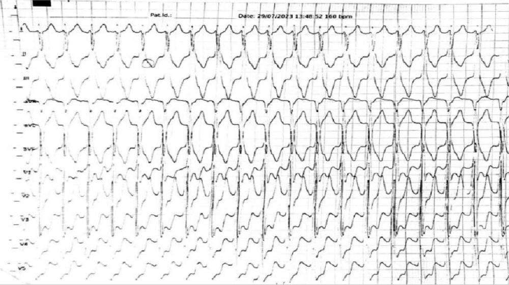 SCMRorg's tweet card. A Heart of Stone Presenting with Ventricular Tachycardia: Behavior of Myocardial Calcium on CMR |...
