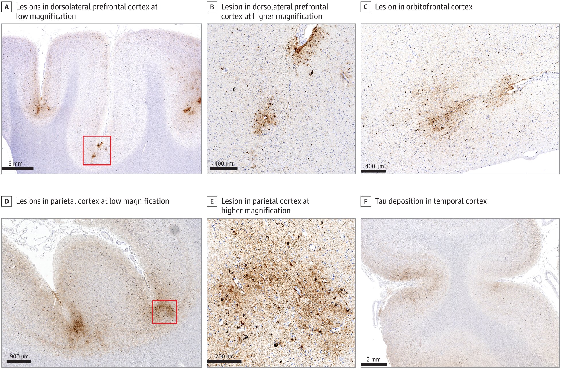 StopCTE's tweet card. This case study of a whole brain specimen from a deceased US military donor exposed to repetitive high-speed boat impacts with waves presents the results of a neuropathological evaluation for chronic...