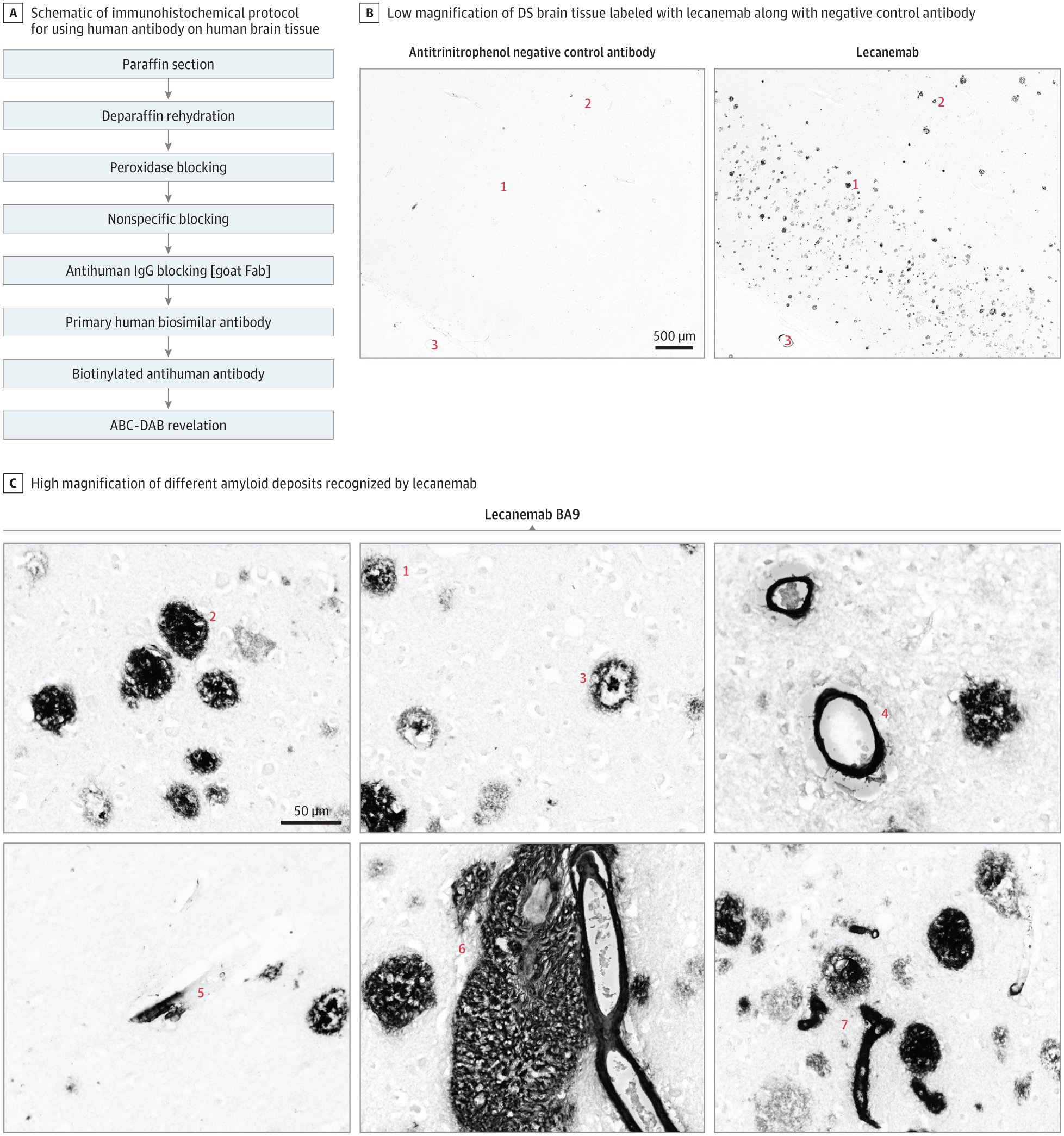 BaaylaB's tweet card. This study investigates the binding properties of lecanemab in the brains of people with Down syndrome, in anticipation of their inclusion in clinical trials or access to antiamyloid immunotherapies.