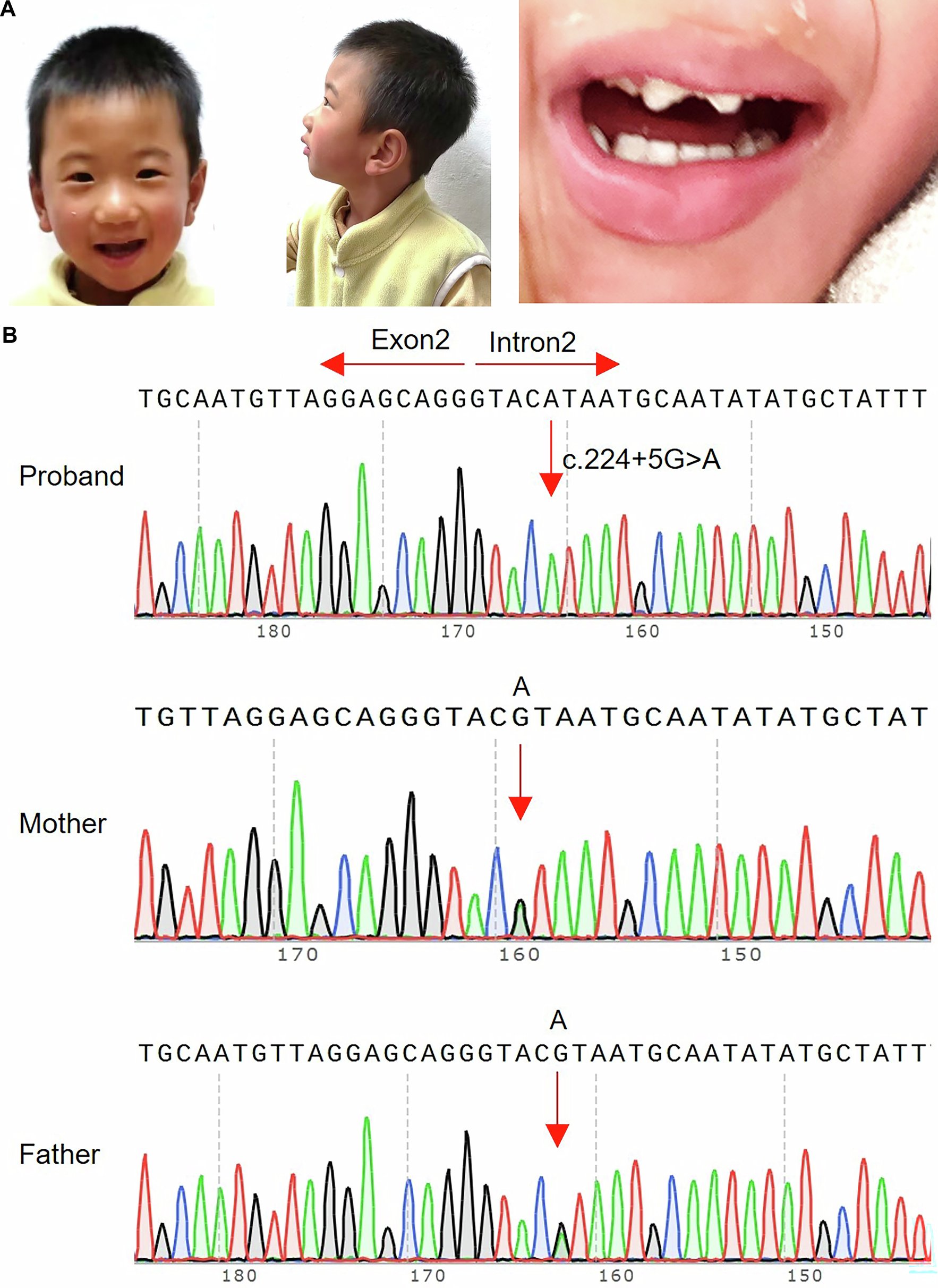JSHGofficialPR's tweet card. Journal of Human Genetics - Microcephaly-related global developmental delay caused by a pathogenic METTL5 splicing mutation in a Chinese family