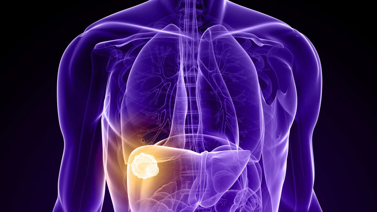 UCLAHealthJCCC's tweet card. A new study may help explain why certain liver tumors return quickly after thermal ablation, a widely used minimally-invasive, image-guided technique that kills cancer cells by applying intense heat...