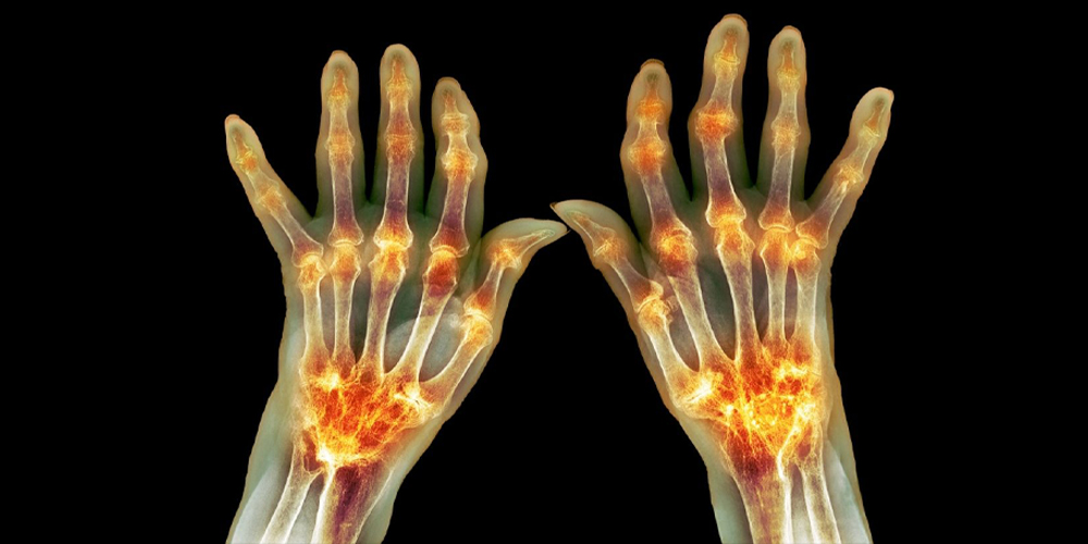 ASBMB's tweet card. Researchers in the Netherlands use mass spectrometry to compare the proteome of plasma and synovial fluid in rheumatoid arthritis patients and find a correlation. Read more about this recent paper in...