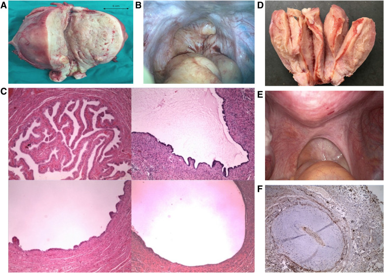 EndoExplained's tweet card. In their large, retrospective, ADenomyosis and its Effect on Neonatal and Obstetric Outcomes study, Dr Rees and colleagues recorded significant adverse reproductive outcomes in women with histologi...