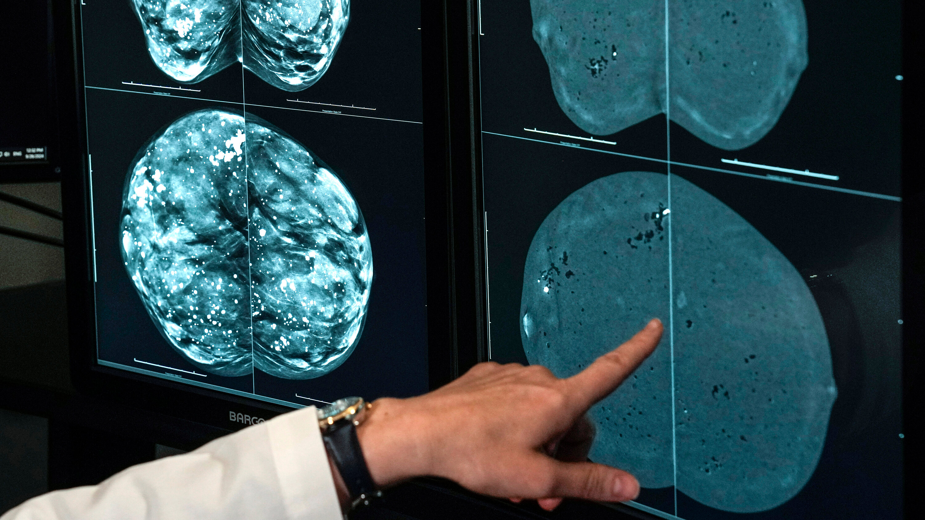 RoniNYTimes's tweet card. Contrast-enhanced mammography identified three times as many tumors as ultrasound scans. But it is not widely used for screening in the United States.