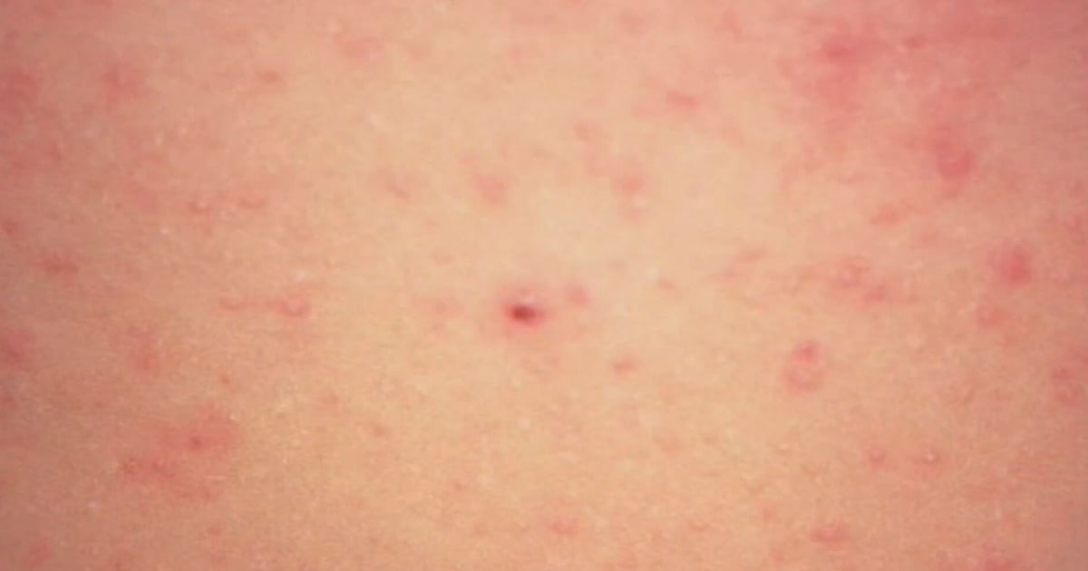 CTVNewsNorthern's tweet card. Another 39 measles cases have been confirmed in the area, Public Health Sudbury and Districts said Friday, with recent exposures to the disease at the Chi-Cheemaun ferry on Manitoulin Island.