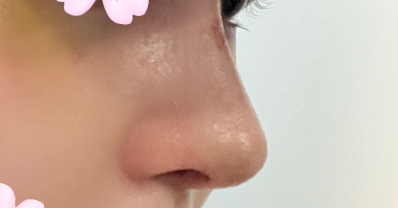 butanukikun_'s tweet card. こんにちは。今年の5月に鼻の修正を韓国でしてきましたのでnoteにまとめます"(∩ˋ͈ ̯ ˊ͈ ∩)"🔥