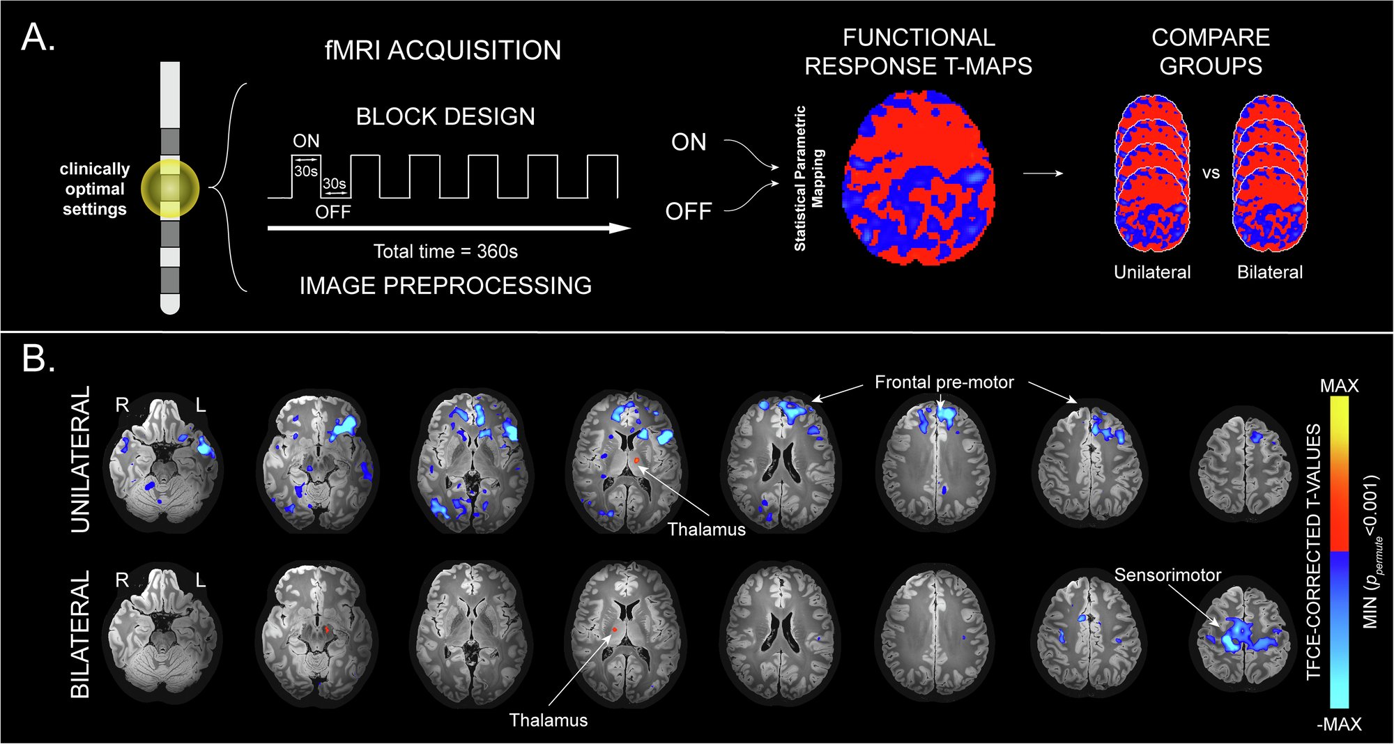 CANSARICA2's tweet card. npj Parkinson's Disease - Functional network differences between unilateral and bilateral deep brain stimulation of the subthalamic nucleus