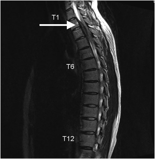 EndoSocJournals's tweet card. Abstract. Rosai-Dorfman disease (RDD) is a rare heterogeneous disorder of non–Langerhans cell histiocytosis. The patient is a 24-year-old woman who present