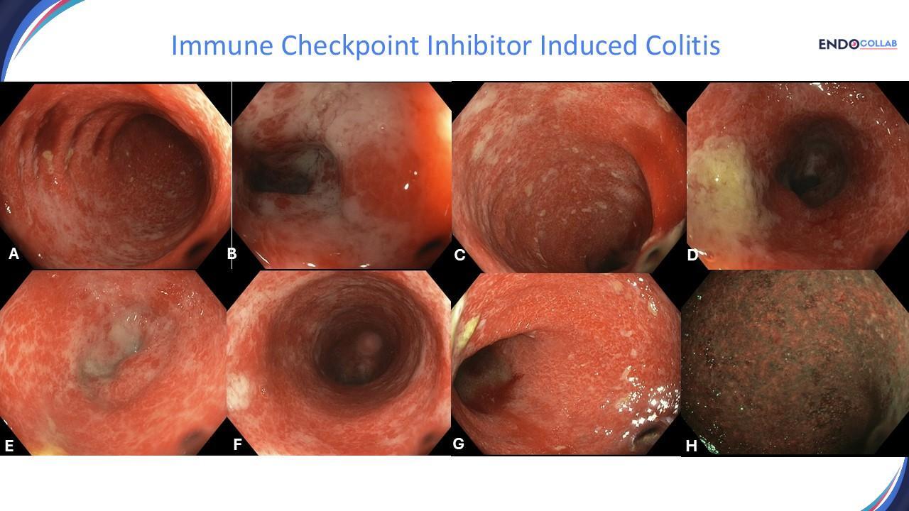EndoCollabcom's tweet card. Explore a rare case of immune checkpoint inhibitor-induced colitis in a 70-year-old melanoma patient, revealing critical insights into this complex treatment-related gastrointestinal complication.