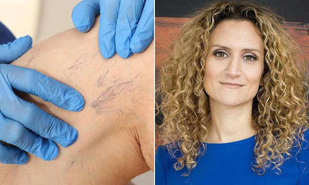 DailyMailUK's tweet card. I have started to get thread veins on my legs and ankles. I hate how they look. Is there anything I can do to get rid of them?