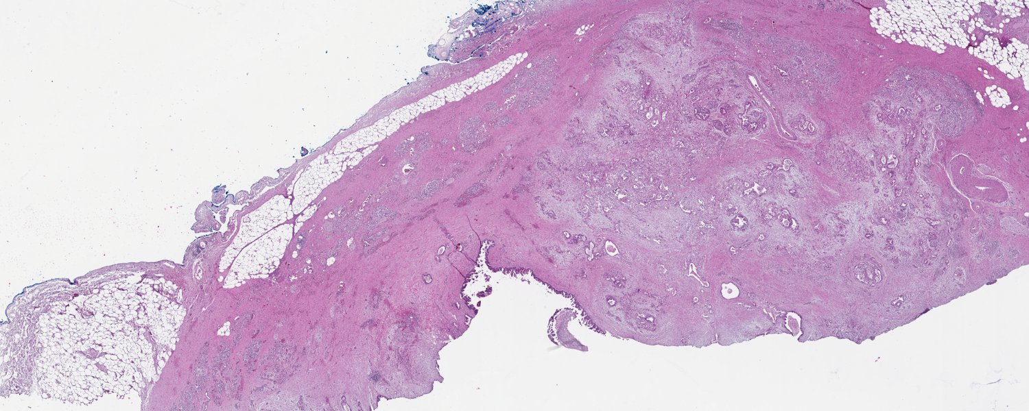 VAInstitute's tweet card. Read about ‘Sugar’ signatures help identify and classify pancreatic cancer cell subtypes on Van Andel Institute – Stay updated on the latest research and groundbreaking discoveries in science and...