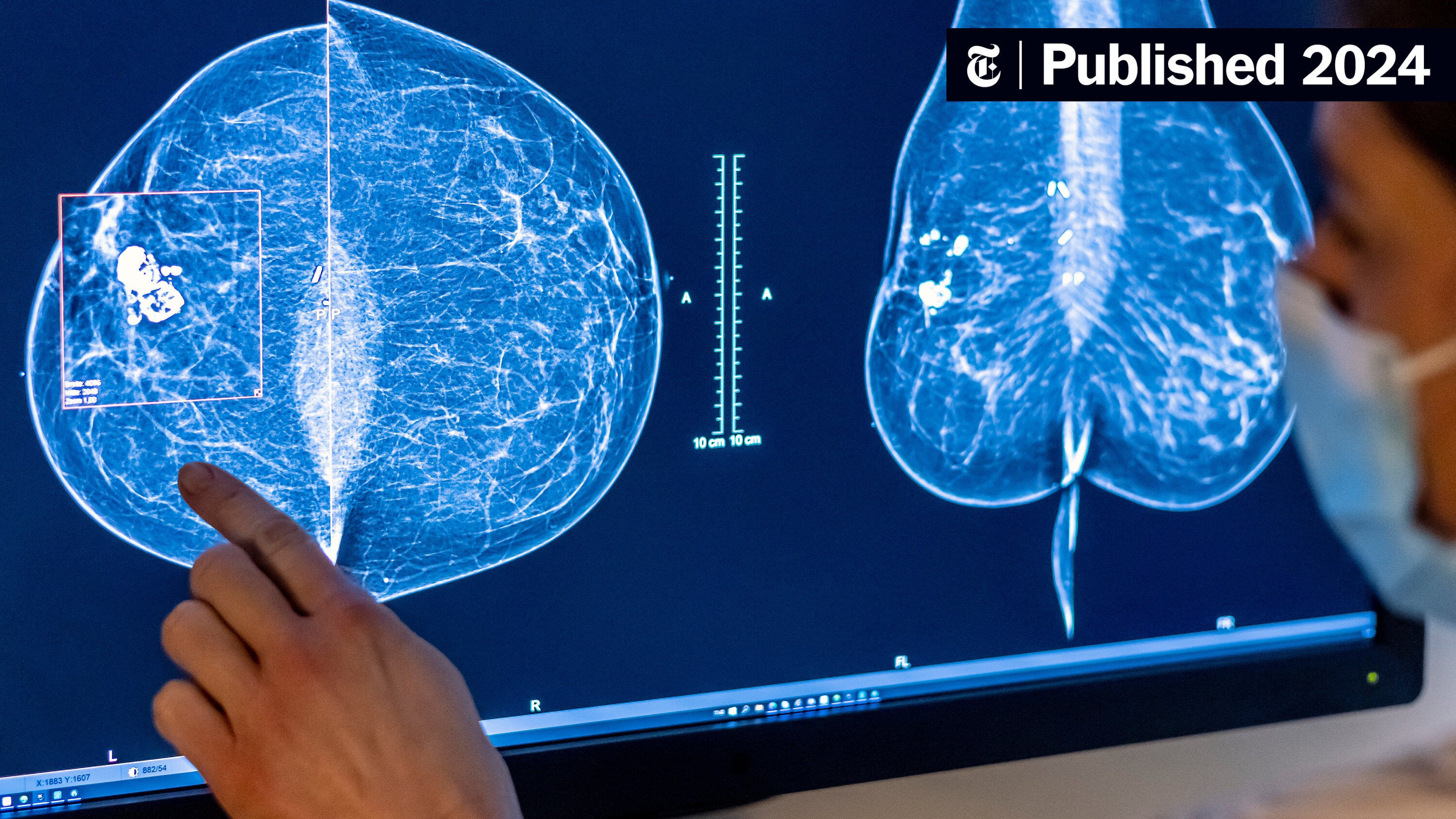 RoniNYTimes's tweet card. Some researchers said the advice did not go far enough. The panel also declined to recommend extra scans for women with dense breast tissue.