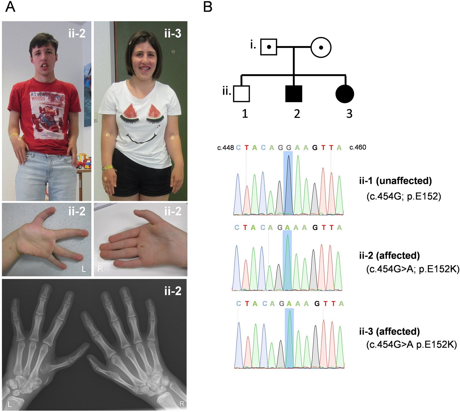 keith_caldecott's tweet card. Human Genetics - Mutations in TDP2, encoding tyrosyl-DNA phosphodiesterase 2, have been associated with a syndromal form of autosomal recessive spinocerebellar ataxia, type 23 (SCAR23). This is a...