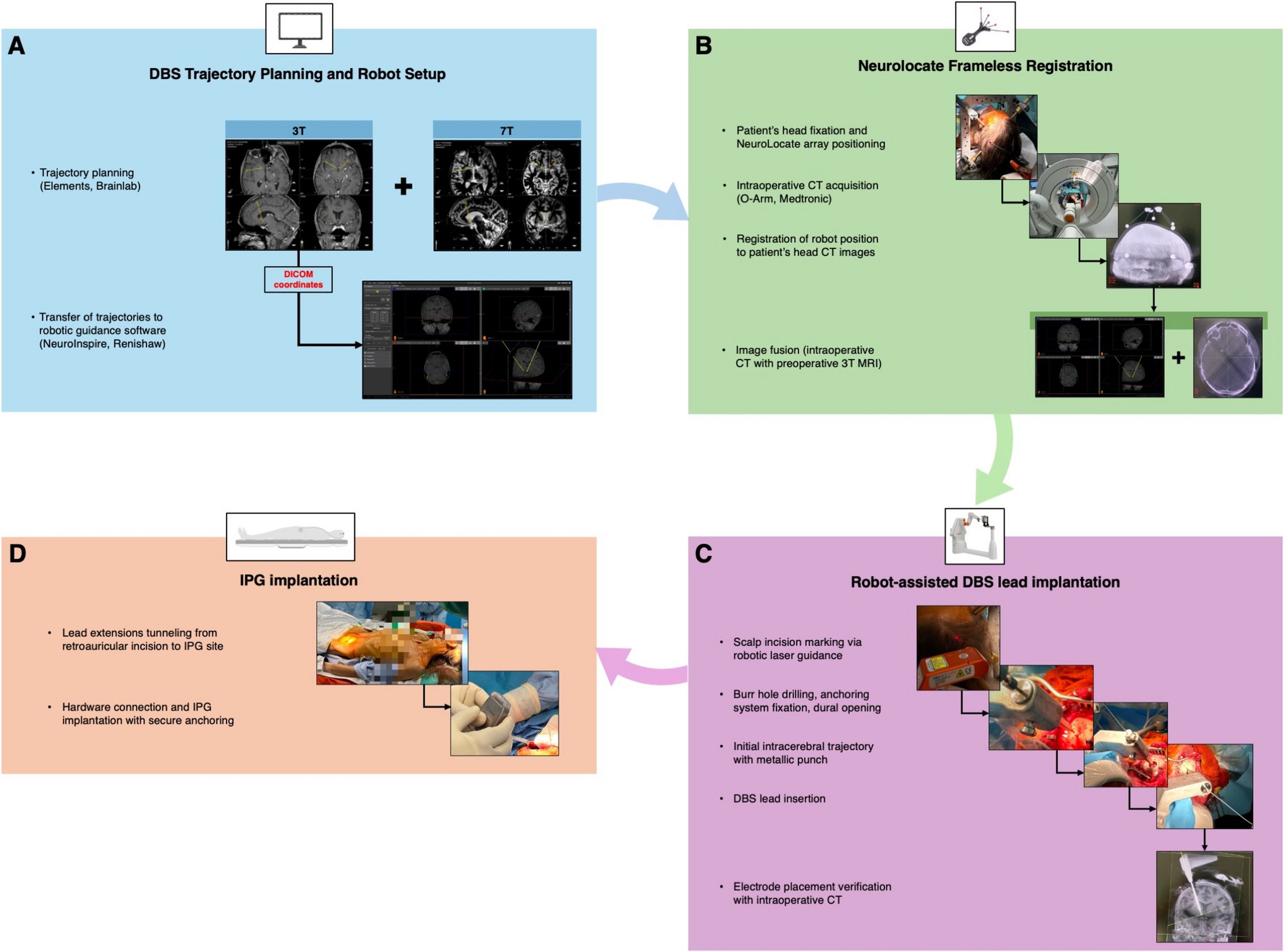ActaNeuro's tweet card. Acta Neurochirurgica - Although stereotactic frame-based techniques remain widely used for deep brain stimulation (DBS) implantation, robot-assisted procedures have demonstrated improved accuracy,...