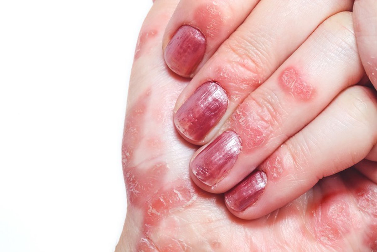 infosalus_com's tweet card. El 28 por ciento de los pacientes con psoriasis presenta afectación genital, y, sin embargo, el 78%...