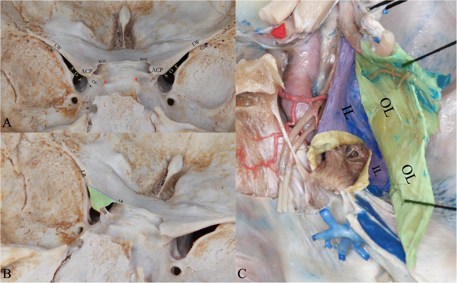ActaNeuro's tweet card. Acta Neurochirurgica - Microsurgical skull base technique continues to be a crucial component in repairing intracranial vascular anomalies and resecting massive lesions. We described a technical...