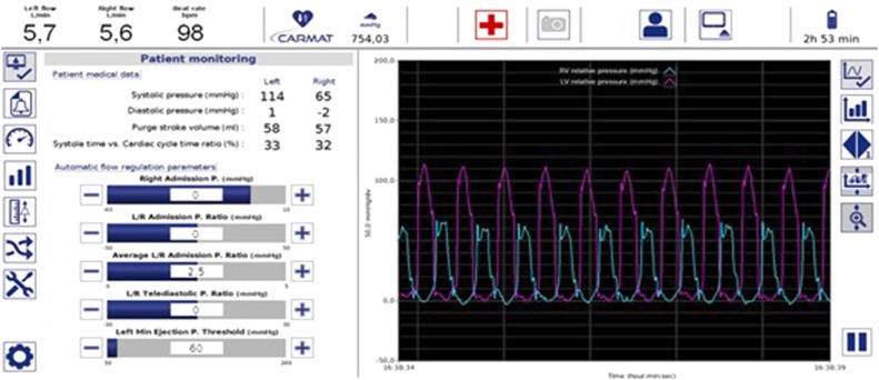 TheJHLT's tweet card. The Aeson total artificial heart (TAH) features embedded pressure sensors for flow autoregulation, which can also be used to estimate pressure gradients. In this bridge-to-transplant study, right and...