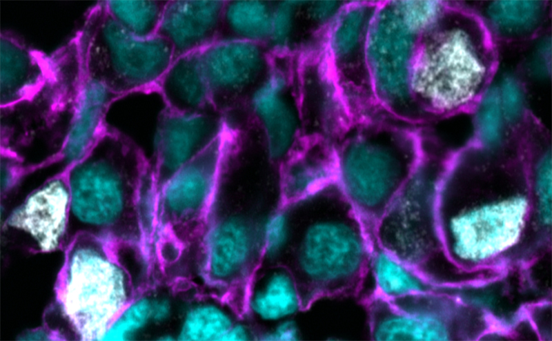 WEHI_research's tweet card. WEHI researchers have discovered a promising new strategy to suppress the growth of aggressive and hard-to-treat cancers by targeting a specialised molecular process known as ‘minor splicing’.