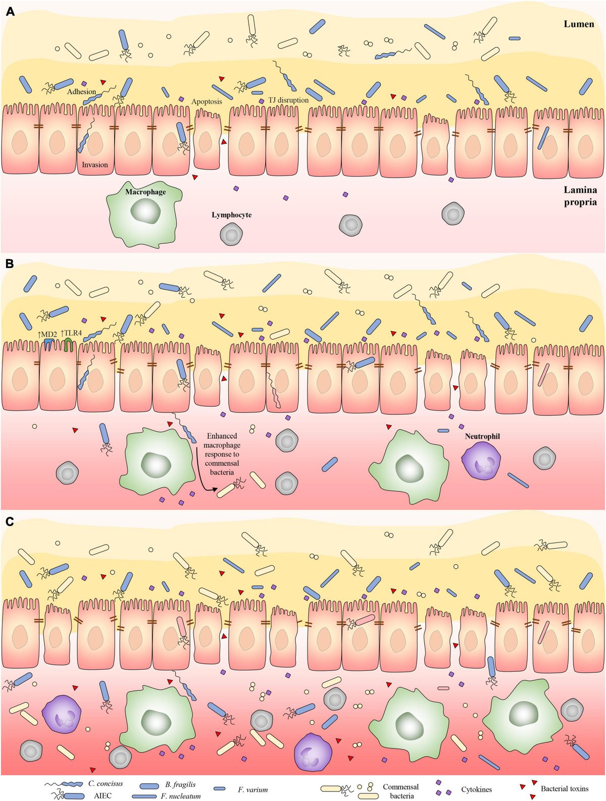 NNaidovski's tweet card. Inflammatory bowel disease (IBD) is a chronic inflammatory condition of the gastrointestinal tract with unknown etiology. The pathogenesis of IBD results fro...