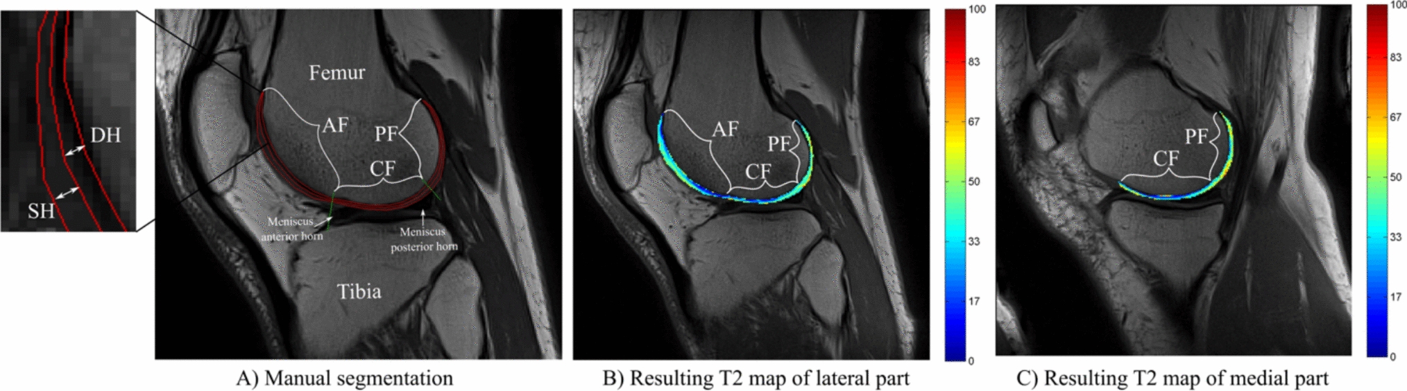 MonteA_biomech's tweet card. European Journal of Applied Physiology - In an asymptomatic population, we investigated the relationships between glycated haemoglobin (HbA1c) and cartilage T2 relaxation time at the knee joint...