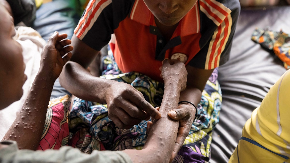 AHeissel's tweet card. Mpox-epidemien udvikler sig dag for dag i Afrika, men de afgørende vacciner fra danske Bavarian Nordic mangler. Prisen er alt for høj, lyder det fra kritikere.
