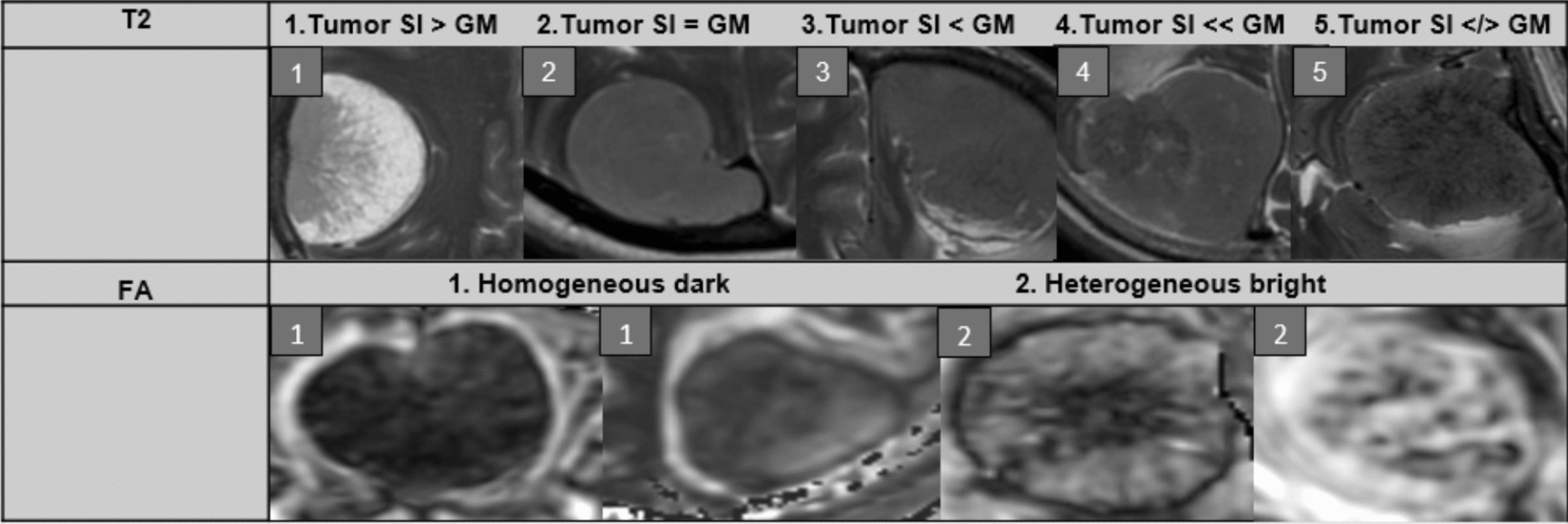 ActaNeuro's tweet card. Acta Neurochirurgica - Symptomatic meningiomas may require surgical resection to save or improve neurological function. The extent of tumor resection depends on multiple factors, including the...