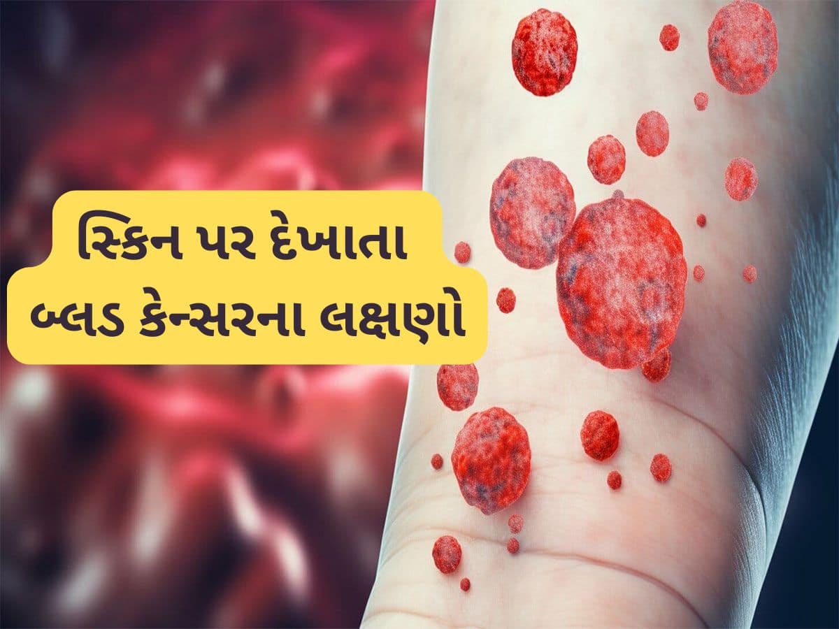 Zee24Kalak's tweet card. Blood Cancer Types and Symptoms: દર વર્ષે કેન્સરના કારણે જીવ ગુમાવતા લોકોની સંખ્યા લાખોમાં હોય છે. આ બીમારીમાં શરુઆતી સ્ટેજમાં લક્ષણો દેખાય જાય અને ઈલાજ શરુ કરી દેવામાં આવે તો વ્યક્તિનો જીવ બચી શકે...