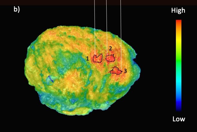 VanderbiltENT's tweet card. Research found that using data collected both during surgery and after a tumor’s removal can help guide surgeons in achieving a negative margin in cancer resection.