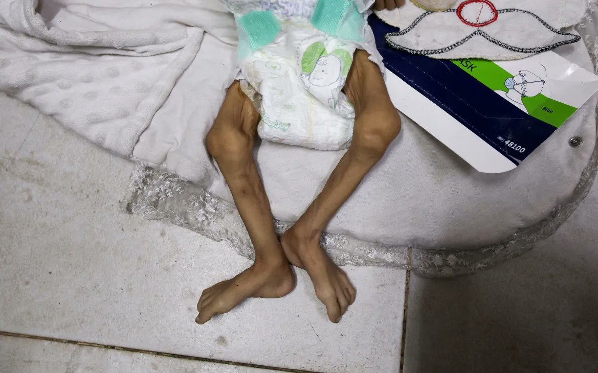 PalestineDays's tweet card. DaysofPla - Malnutrition in the Gaza Strip has reached "alarming levels," according to a severe warning from the World Health Organization (WHO), which also