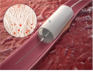 VascularNews's tweet card. StentIt has launched a first-in-human trial of its Resorbable Fibrillated Scaffold (RFS) for the treatment of below-the-knee CLTI.