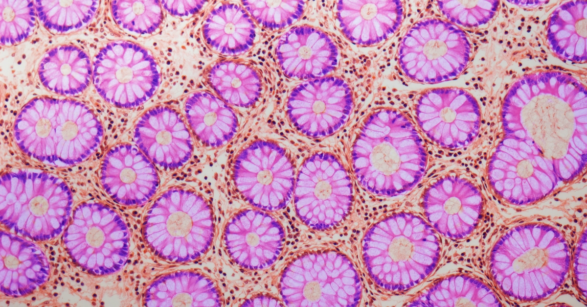 UMIntMed's tweet card. New basic science insights into programmed cell death could offer relief for inflammatory bowel disease. The University of Michigan study reveals a connection between lipid reactive oxygen species,...