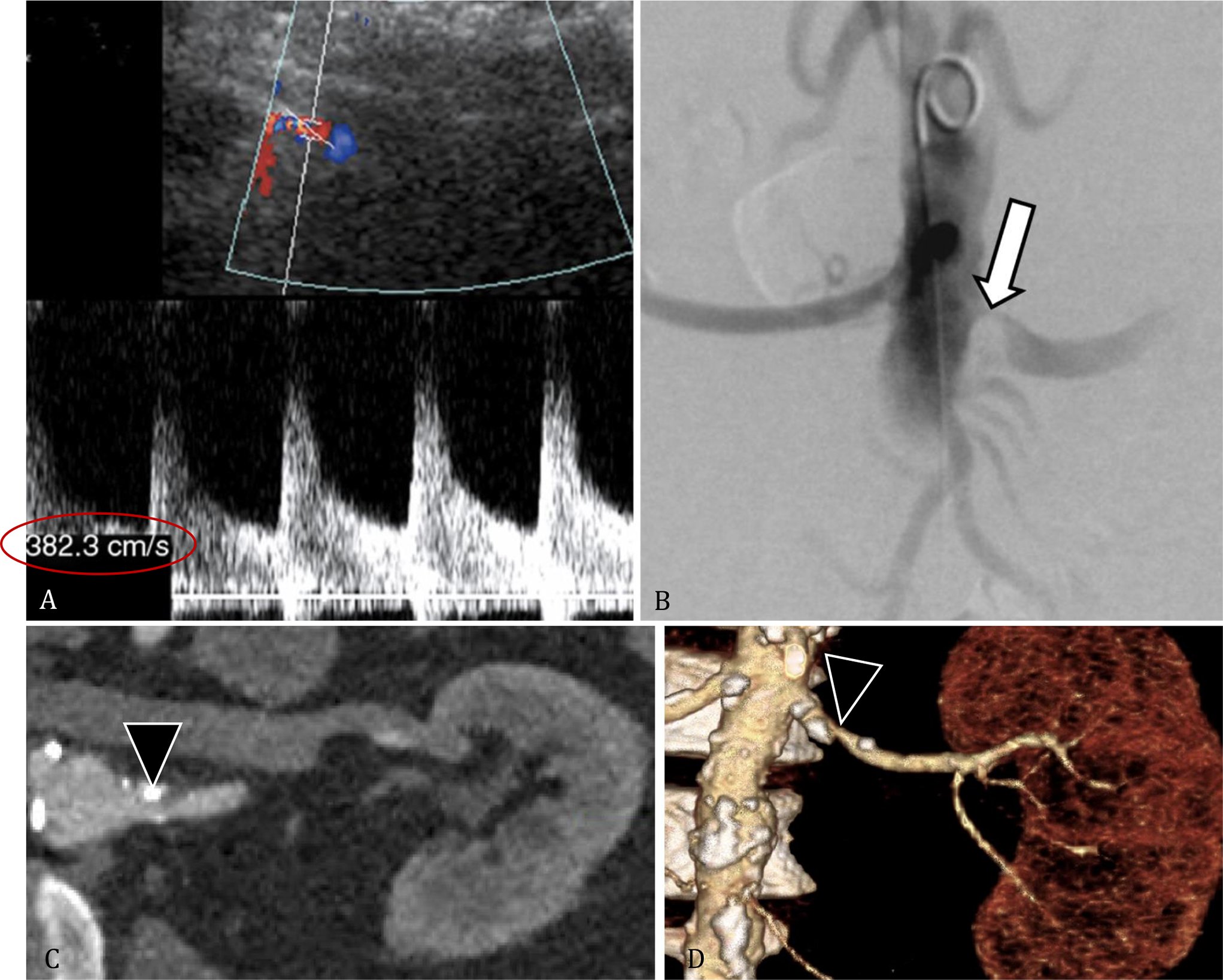 Abdominal_Rad's tweet card. Abdominal Radiology - Renovascular hypertension (RVHT) is an important cause of secondary hypertension, accounting for approximately 75% of cases. This pictorial review describes the imaging...