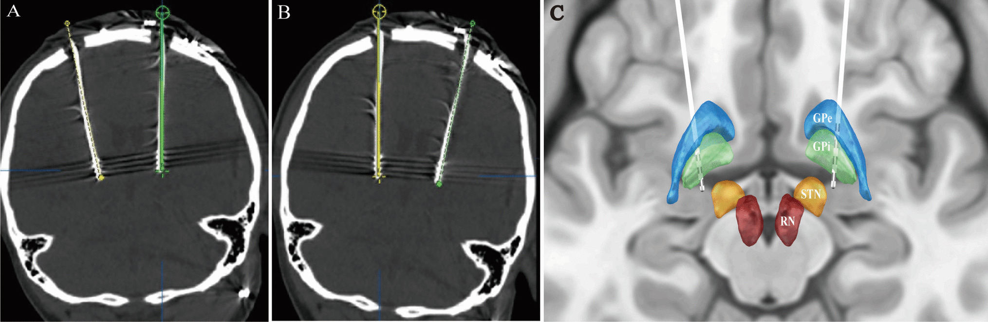 ActaNeuro's tweet card. Acta Neurochirurgica - Dystonia is a rare neurologic disorder that affects patients’ quality of life. Globus pallidus internus (GPi) deep brain stimulation (DBS) is an effective treatment for...