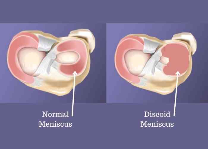 thekneedoc's tweet card. Due to the degenerative nature of the discoid meniscus Dr. LaPrade performs discoid meniscus surgery inside out sutures, rather than all inside devices.