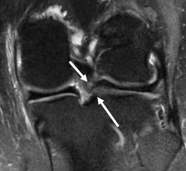 thekneedoc's tweet card. A posterior horn lateral meniscus tear is usually due to twisting or turning activities or falls. Lateral meniscal tears are common in sports such as skiing