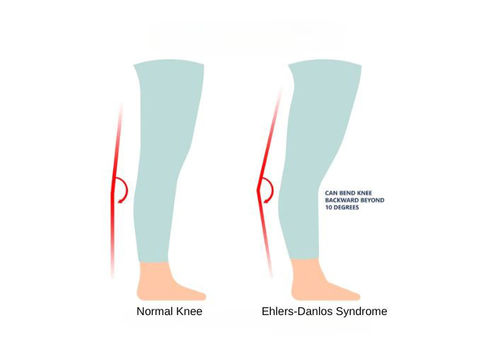 thekneedoc's tweet card. Ehlers-Danlos Syndrome (EDS) is a group of genetically inherited diseases that involve soft connective tissue by disrupting the production of normal collagen.