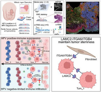 ST_Omics's tweet card. This study uses single-nucleus RNA sequencing and spatial transcriptomics to investigate penile squamous cell carcinoma (PSCC). It reveals that PSCC tumor cells mimic normal penile epithelium...