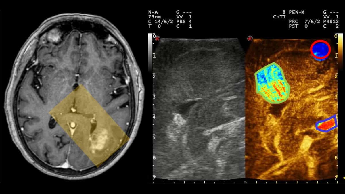 FUSFoundation's tweet card. Understanding cerebral microbubble distribution could open up new avenues for ultrasound-based imaging and therapies